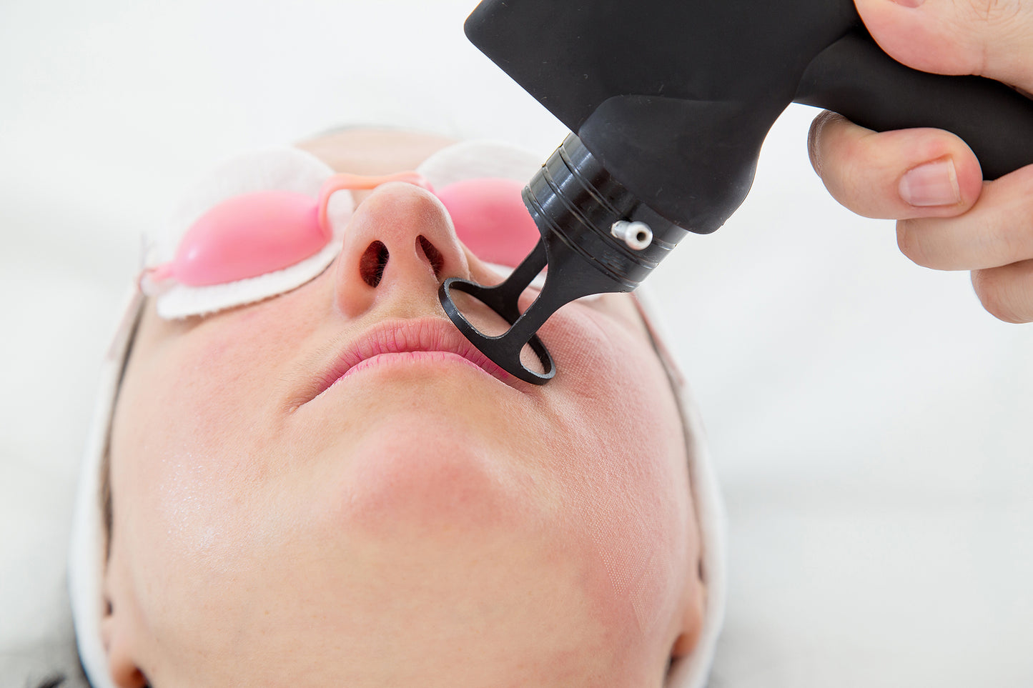 Erbium Laser Resurfacing