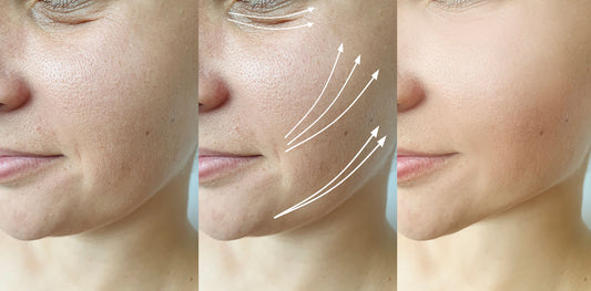 Non-surgical Laser Facelift